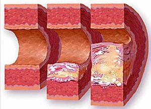 Stages of atheromatous plaque development in a vessel with hypertension